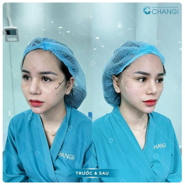 ACF Image